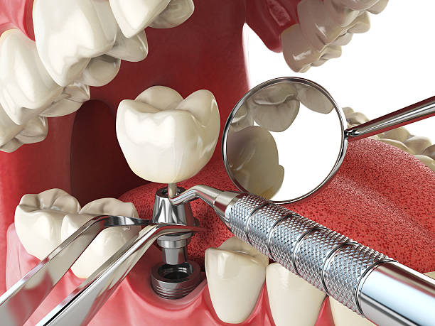 Best Emergency Dental Extractions in Quartz Hill, CA
